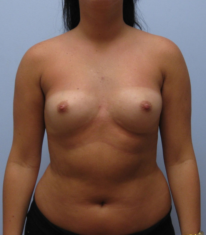 Breast Augmentation Before & After Image