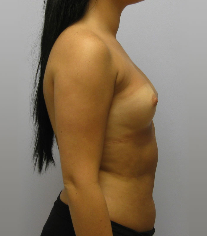 Breast Augmentation Before & After Image