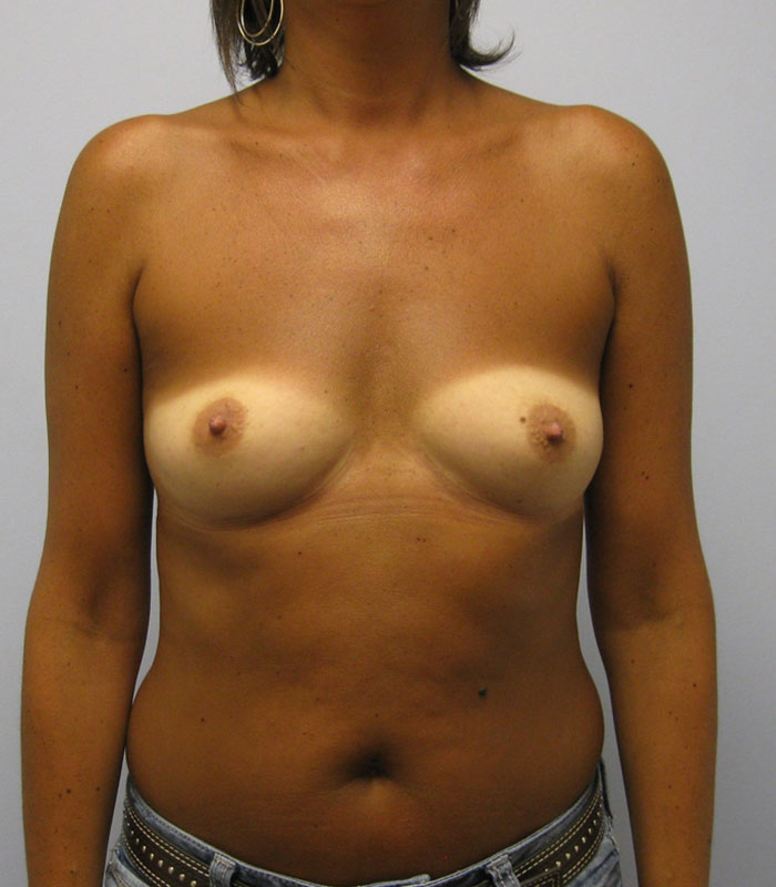 Breast Augmentation Before & After Image