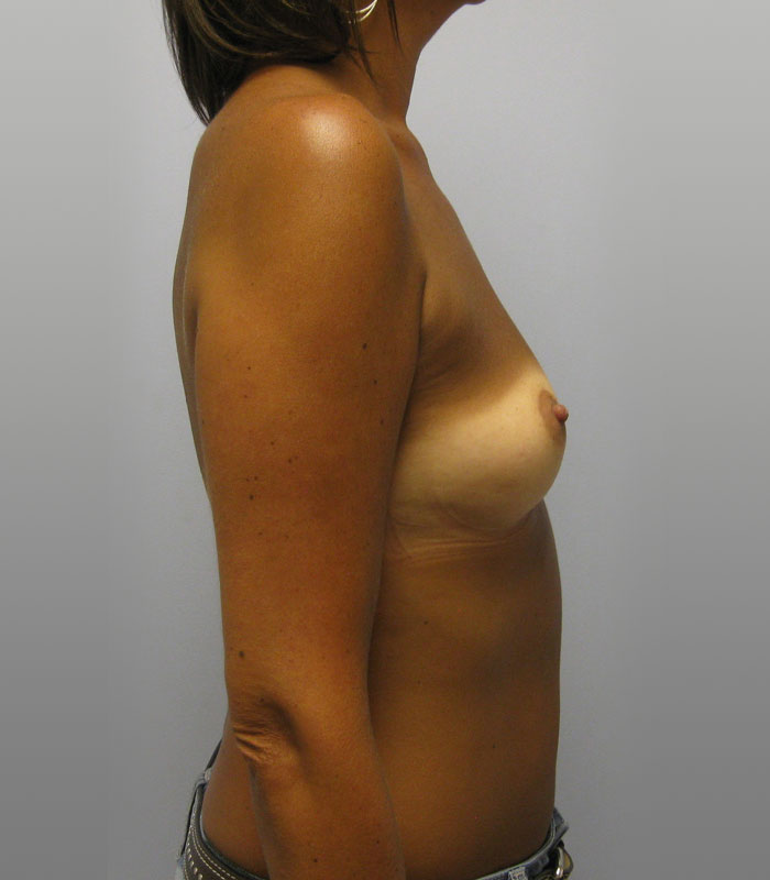 Breast Augmentation Before & After Image