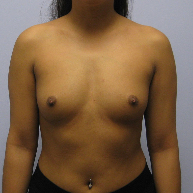 Breast Augmentation Before & After Image