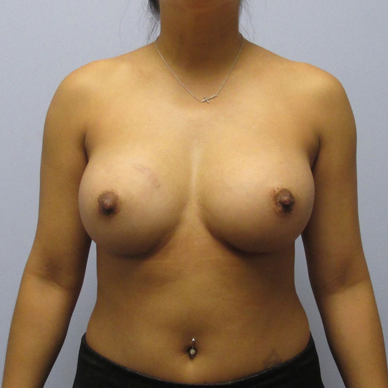 Breast Augmentation Before & After Image