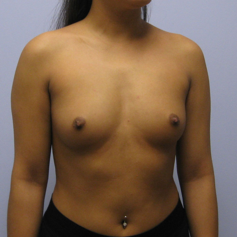 Breast Augmentation Before & After Image