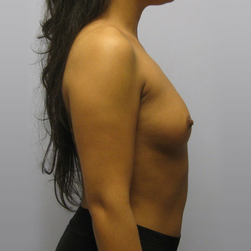 Breast Augmentation Before & After Image