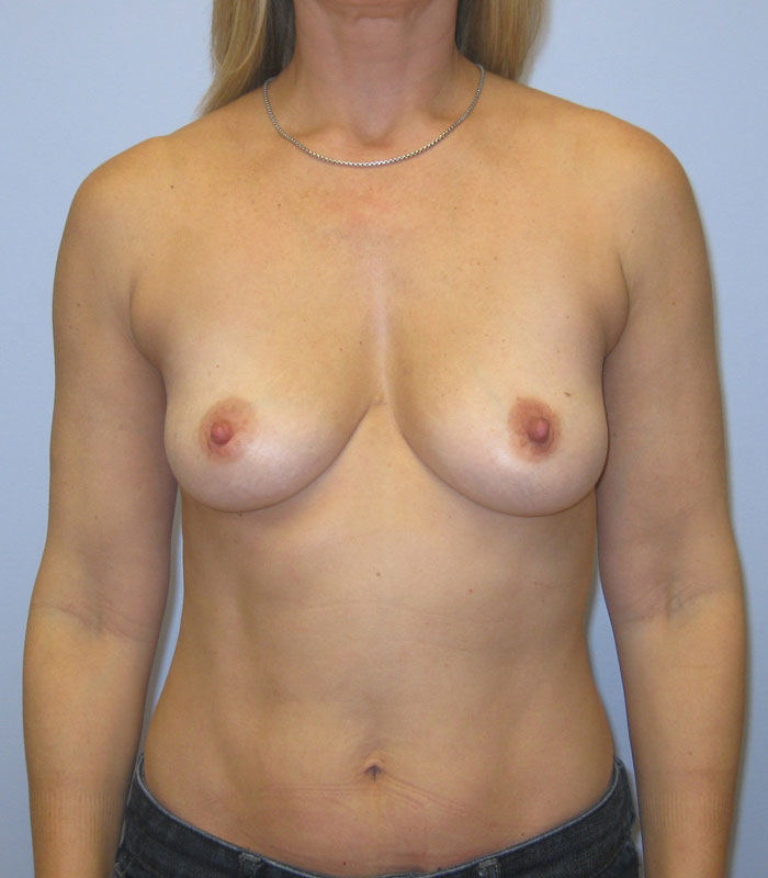 Breast Augmentation Before & After Image