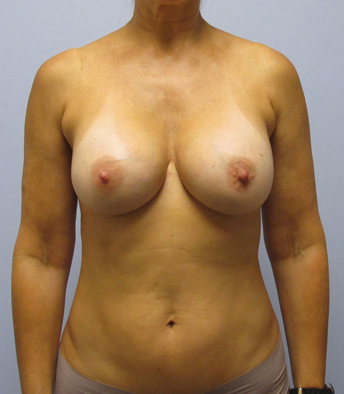 Breast Augmentation Before & After Image