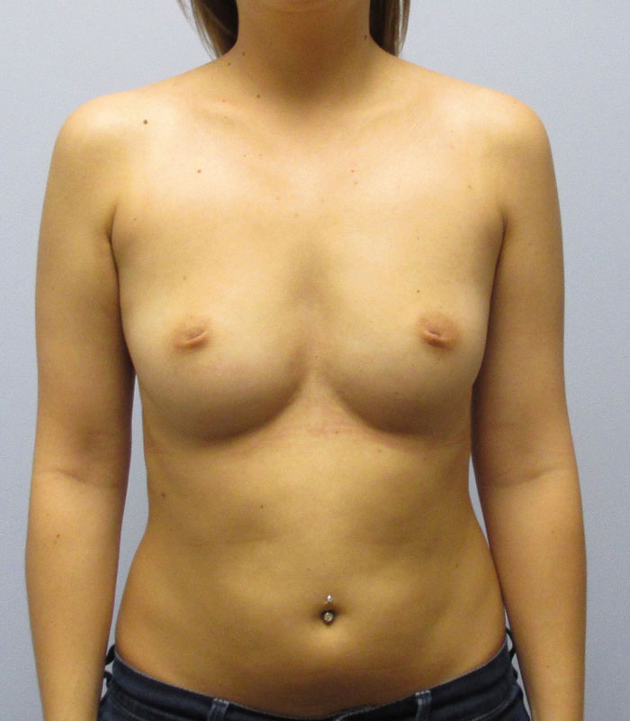 Breast Augmentation Before & After Image