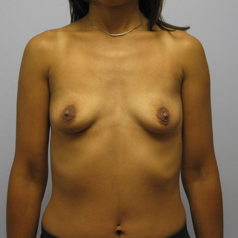 Breast Augmentation Before & After Image