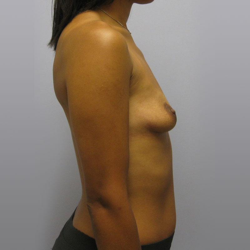 Breast Augmentation Before & After Image