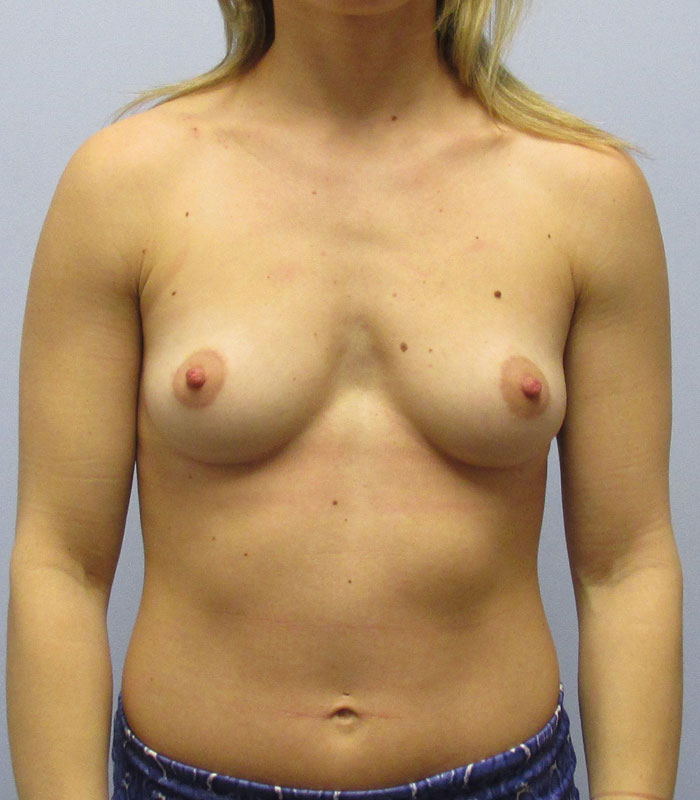 Breast Augmentation Before & After Image