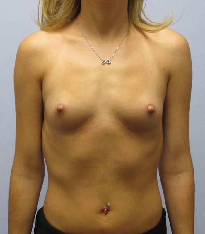 Breast Augmentation Before & After Image