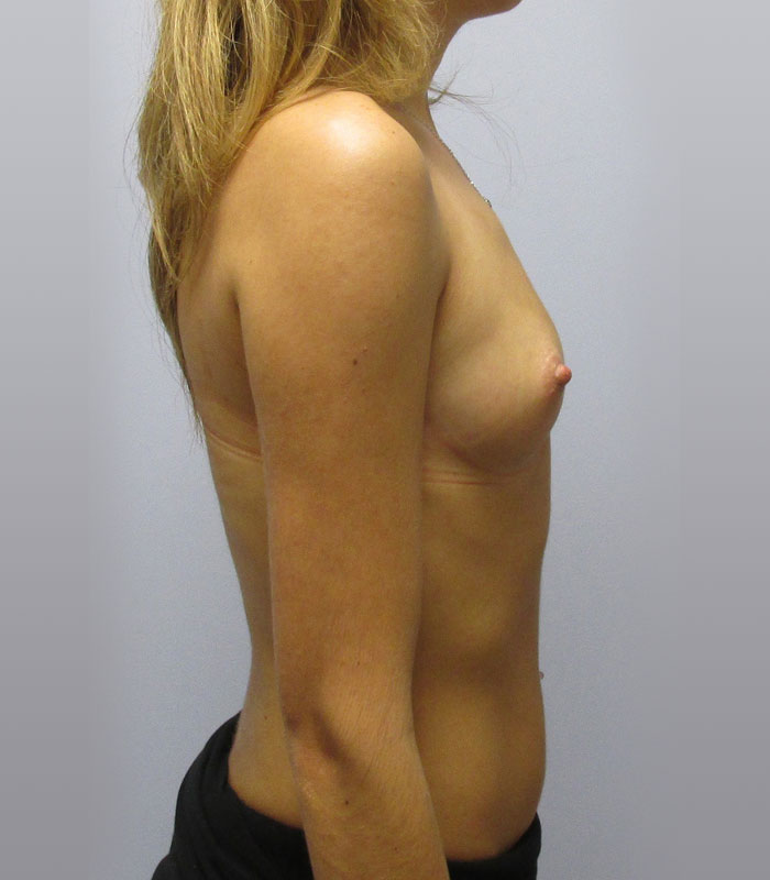 Breast Augmentation Before & After Image