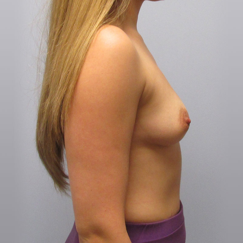 Breast Augmentation Before & After Image