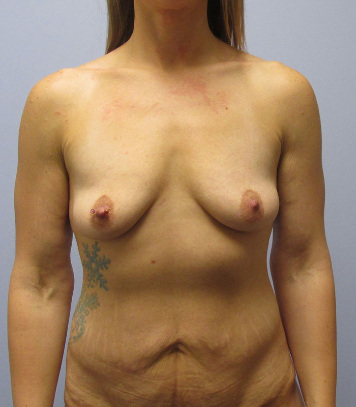 Breast Augmentation Before & After Image