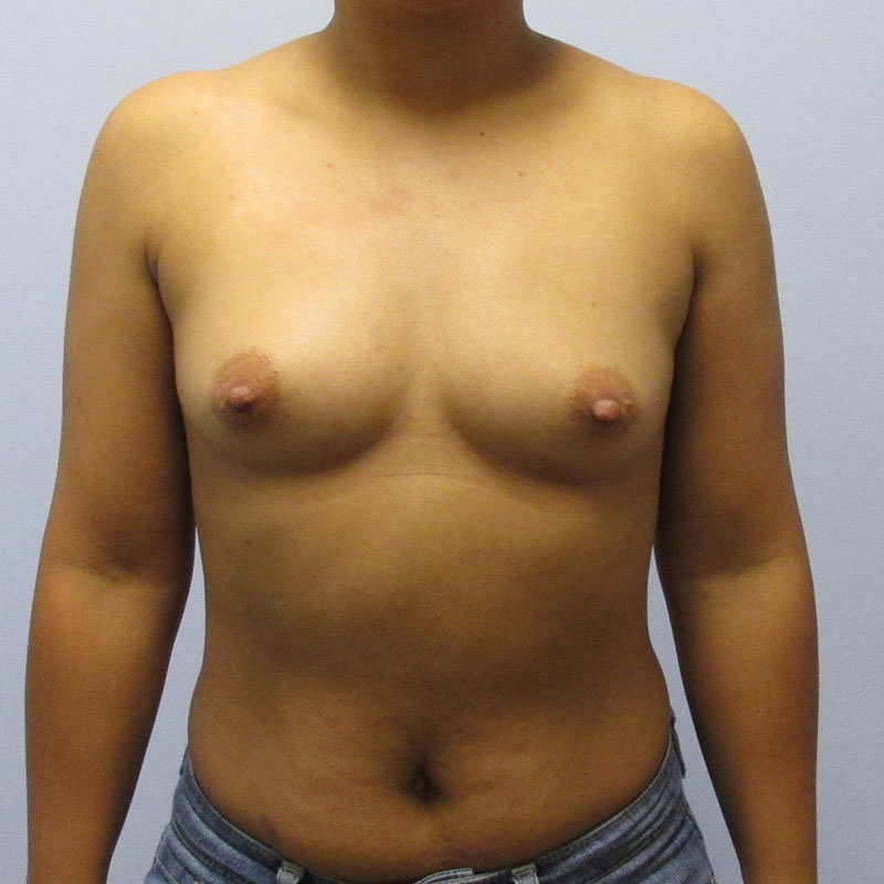 Breast Augmentation Before & After Image