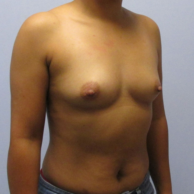 Breast Augmentation Before & After Image