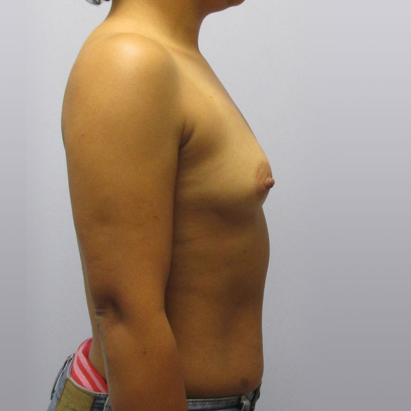 Breast Augmentation Before & After Image