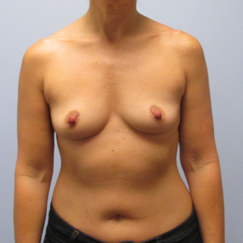 Breast Augmentation Before & After Image