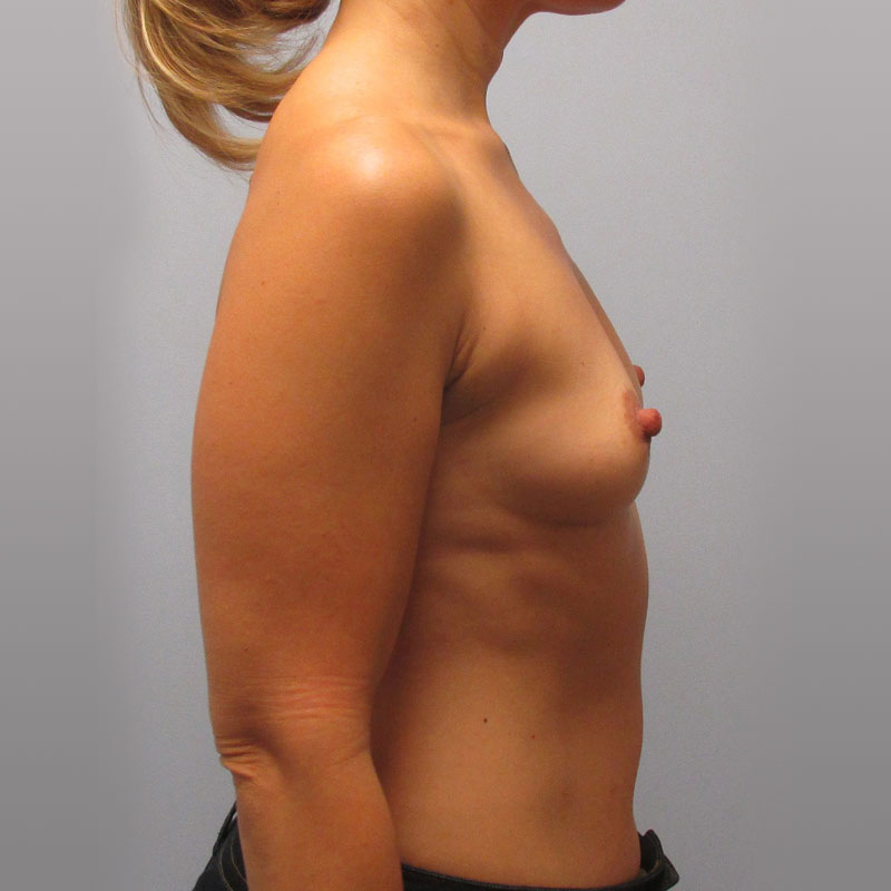 Breast Augmentation Before & After Image