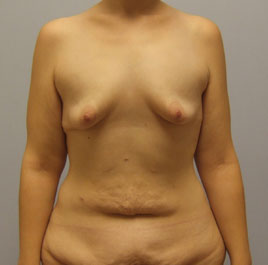 Breast Lift Before & After Image