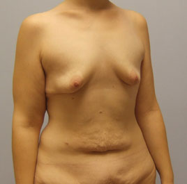 Breast Lift Before & After Image