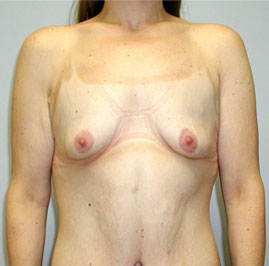 Breast Lift Before & After Image