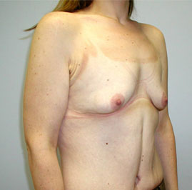 Breast Lift Before & After Image