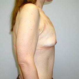 Breast Lift Before & After Image