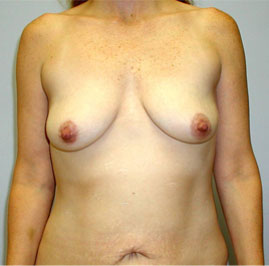 Breast Lift Before & After Image