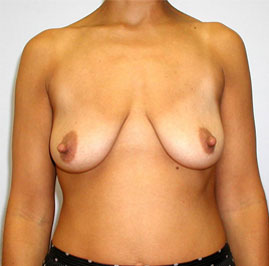 Breast Lift Before & After Image