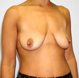 Breast Lift Before & After Image