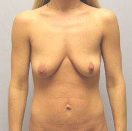 Breast Lift Before & After Image