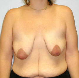 Breast Lift Before & After Image