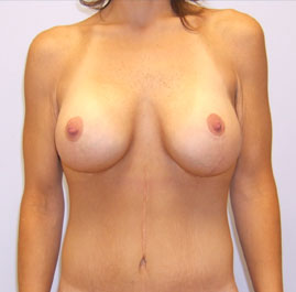 Breast Lift Before & After Image