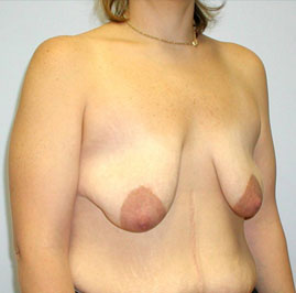 Breast Lift Before & After Image