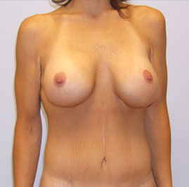 Breast Lift Before & After Image