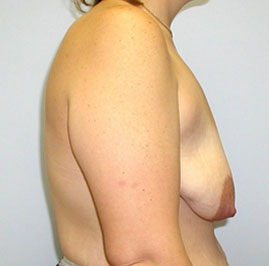 Breast Lift Before & After Image