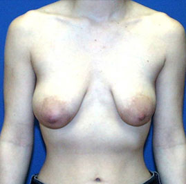 Breast Lift Before & After Image