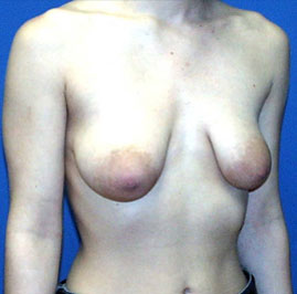 Breast Lift Before & After Image