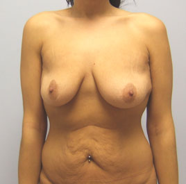 Breast Lift Before & After Image