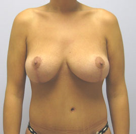 Breast Lift Before & After Image