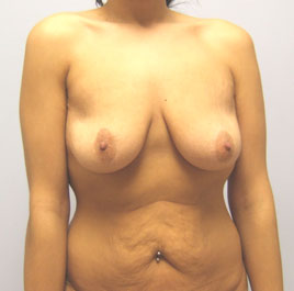 Breast Lift Before & After Image