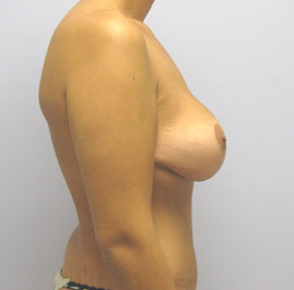 Breast Lift Before & After Image