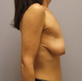 Breast Lift Before & After Image