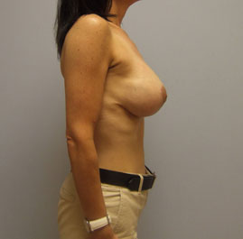 Breast Lift Before & After Image