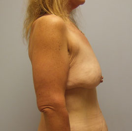 Breast Lift Before & After Image