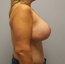 Breast Lift Before & After Image