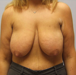 Breast Lift Before & After Image