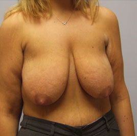 Breast Lift Before & After Image