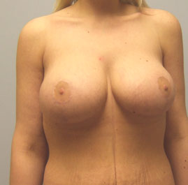 Breast Lift Before & After Image